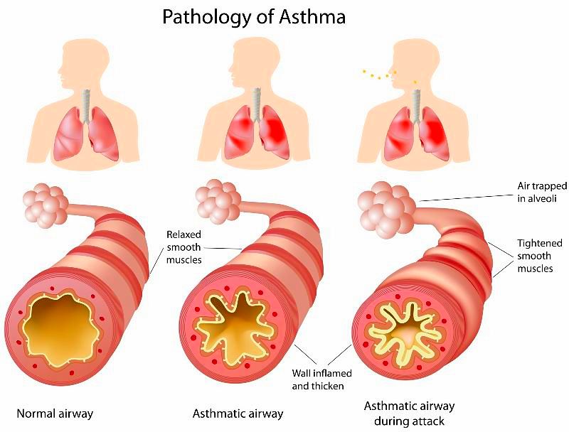 Vitamin D3 Therapy Cures Asthma